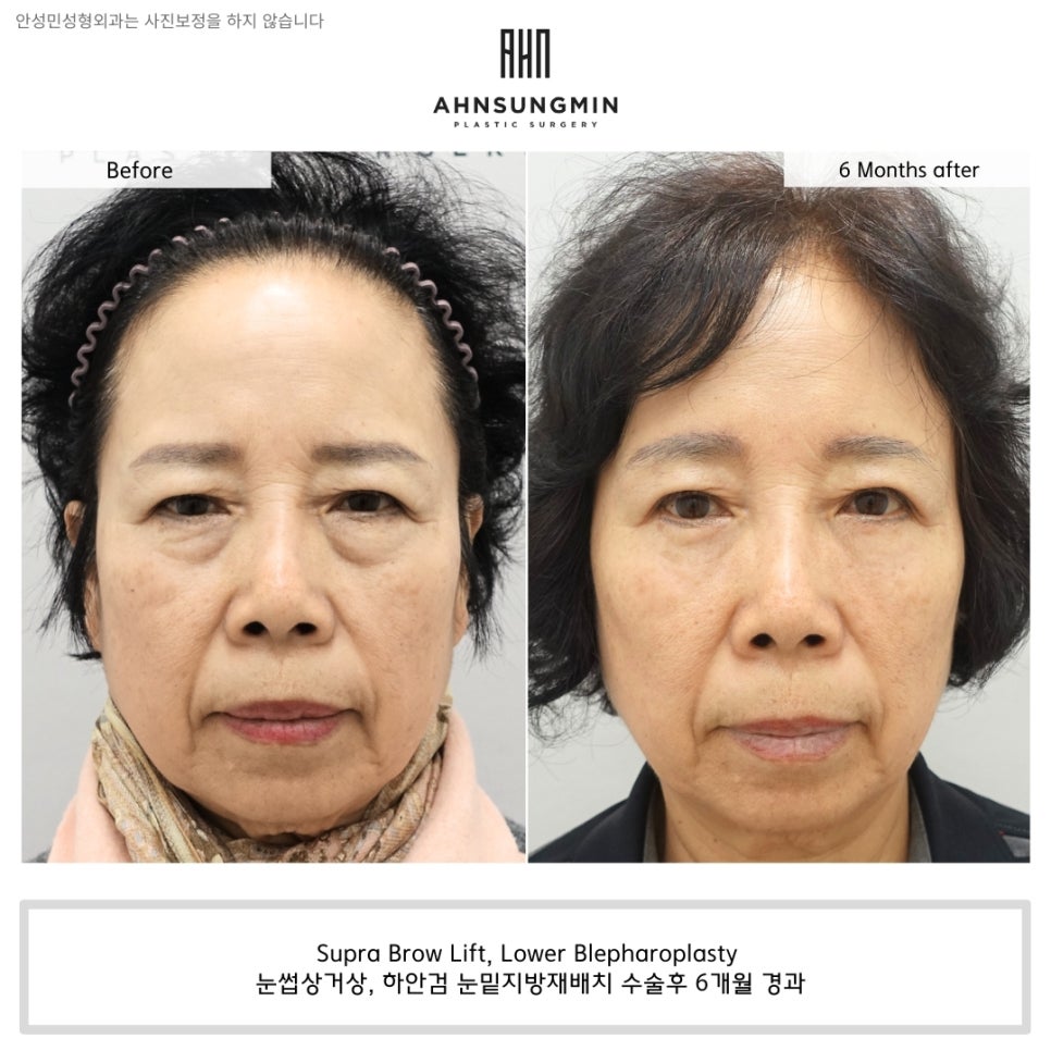 눈꺼풀 처짐을 해결하는 방법, 눈썹 거상 수술이 필요한 경우 관련 이미지 7