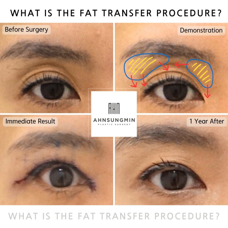 지방이동은 무엇이고 눈 꺼진 눈 수술시 왜 필요 할까요? 관련 이미지 1