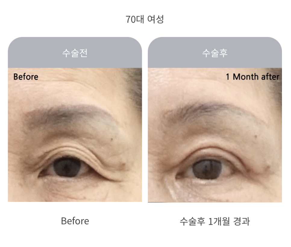 중년 상안검 수술의 특징과 주의사항 관련 이미지 5