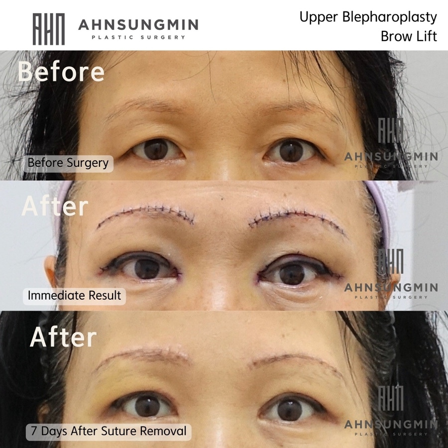 눈썹 상거상과 상안검 수술 관련 이미지 1