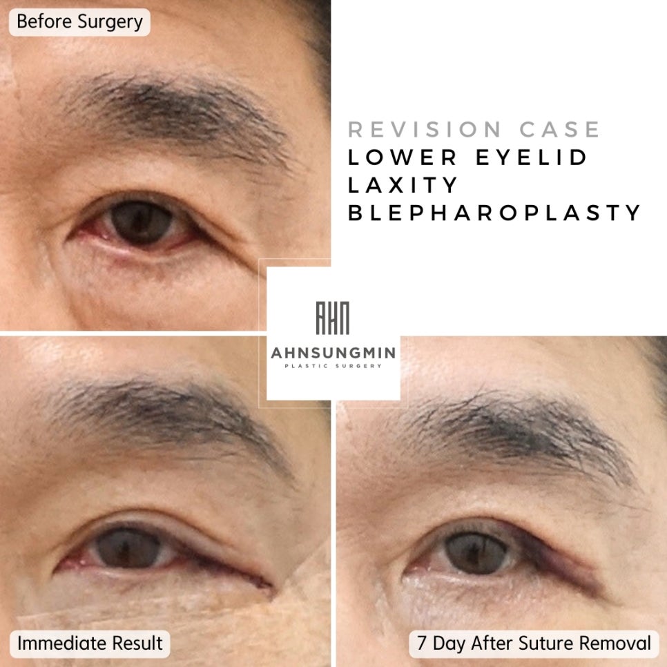 안검외반 부작용 하안검 재수술[성형외과 전문의 재수술] 관련 이미지 2