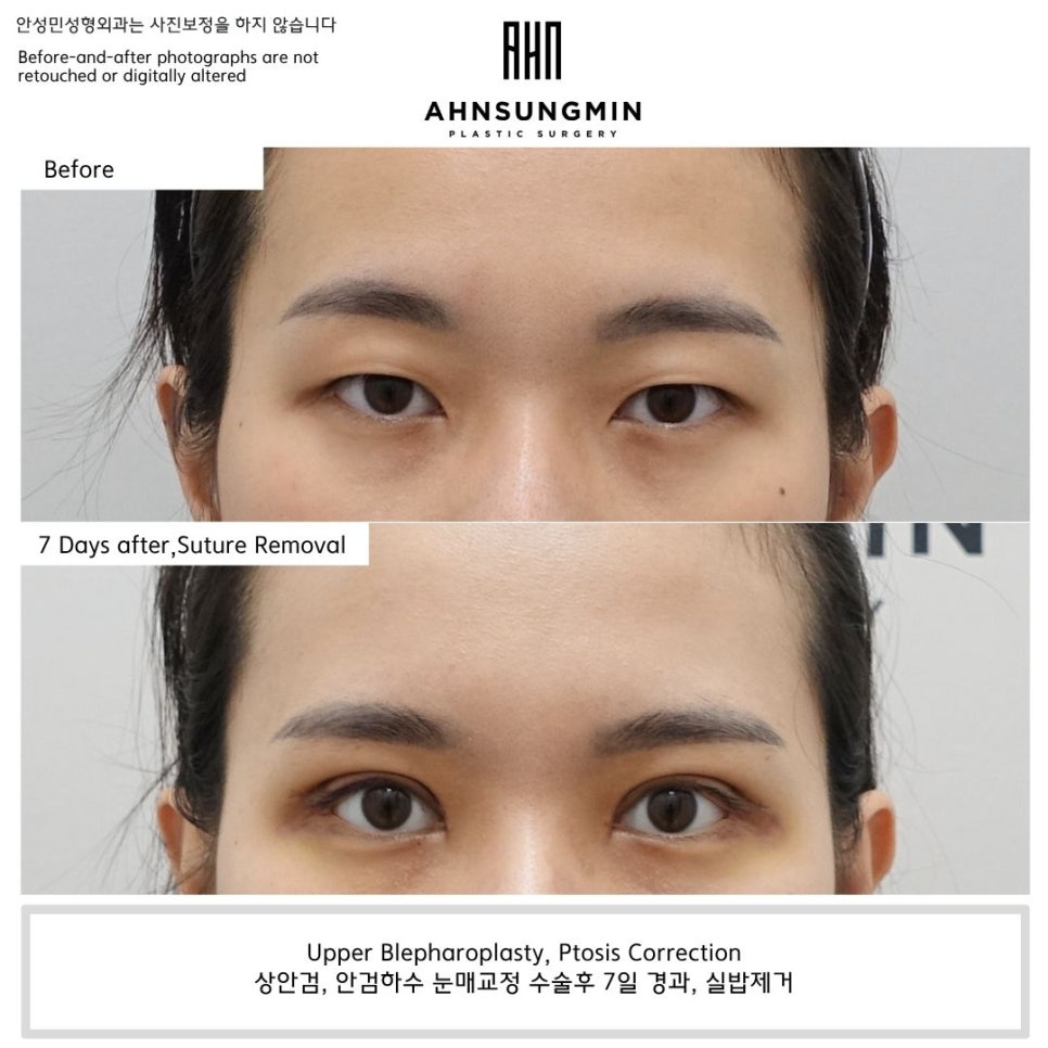 What Does Upper Eyelid and Ptosis Correction Look Like 7 Days After Surgery? image 1