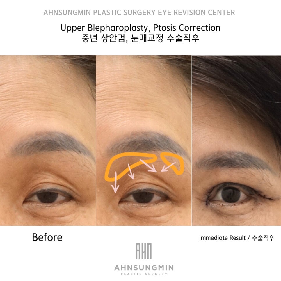 상안검 수술 잘하려면 [성형외과 전문의 안성민] 관련 이미지 3