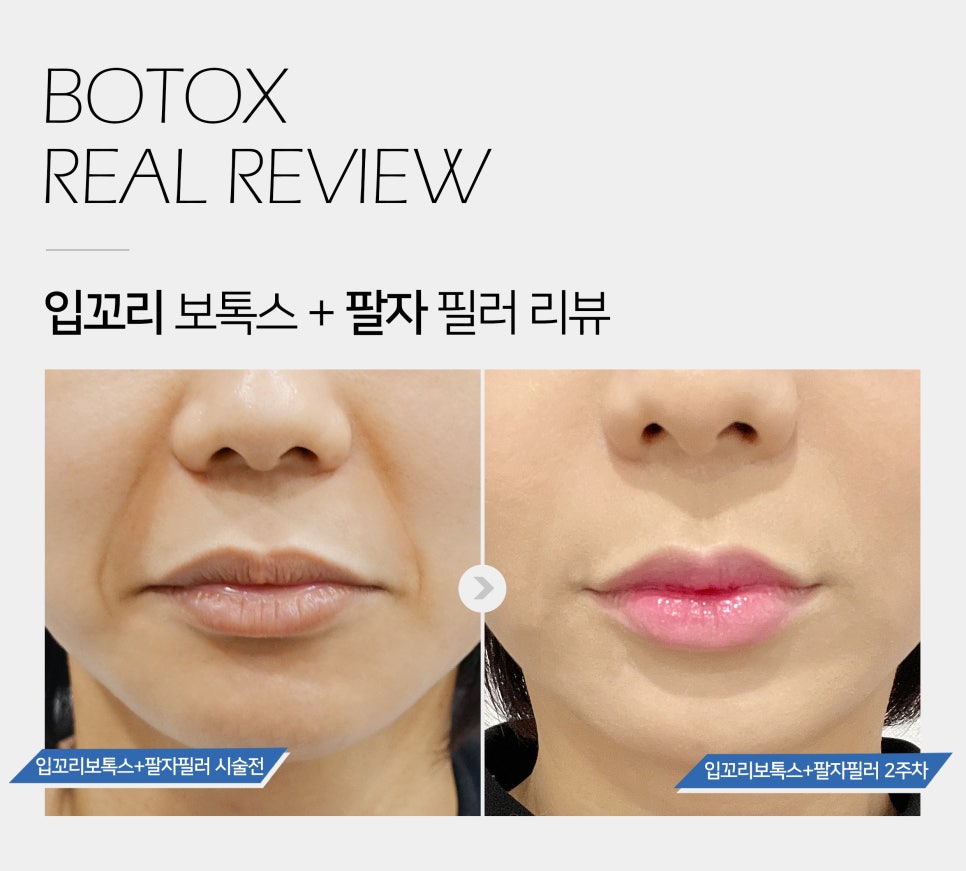 [잠실동성형외과] NO!! 수술없이 예버지는 방법! 입꼬리 보톡스 + 팔자 필러 솔직후기 2주차 리얼후기 / 잠실성형외과 관련 이미지 1