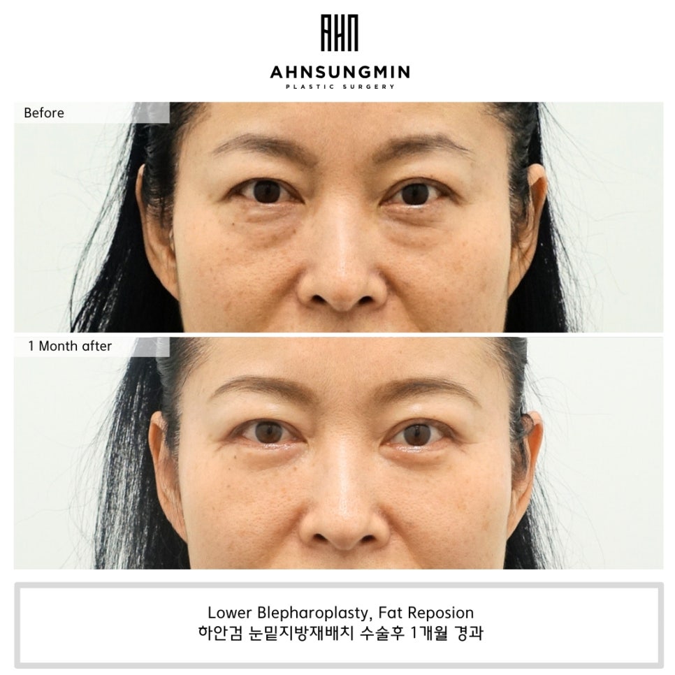 눈밑지방재배치 수술 시 애교 근육을 보존해야 하는 이유 관련 이미지 1