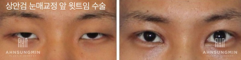 눈매교정 관련 이미지 2
