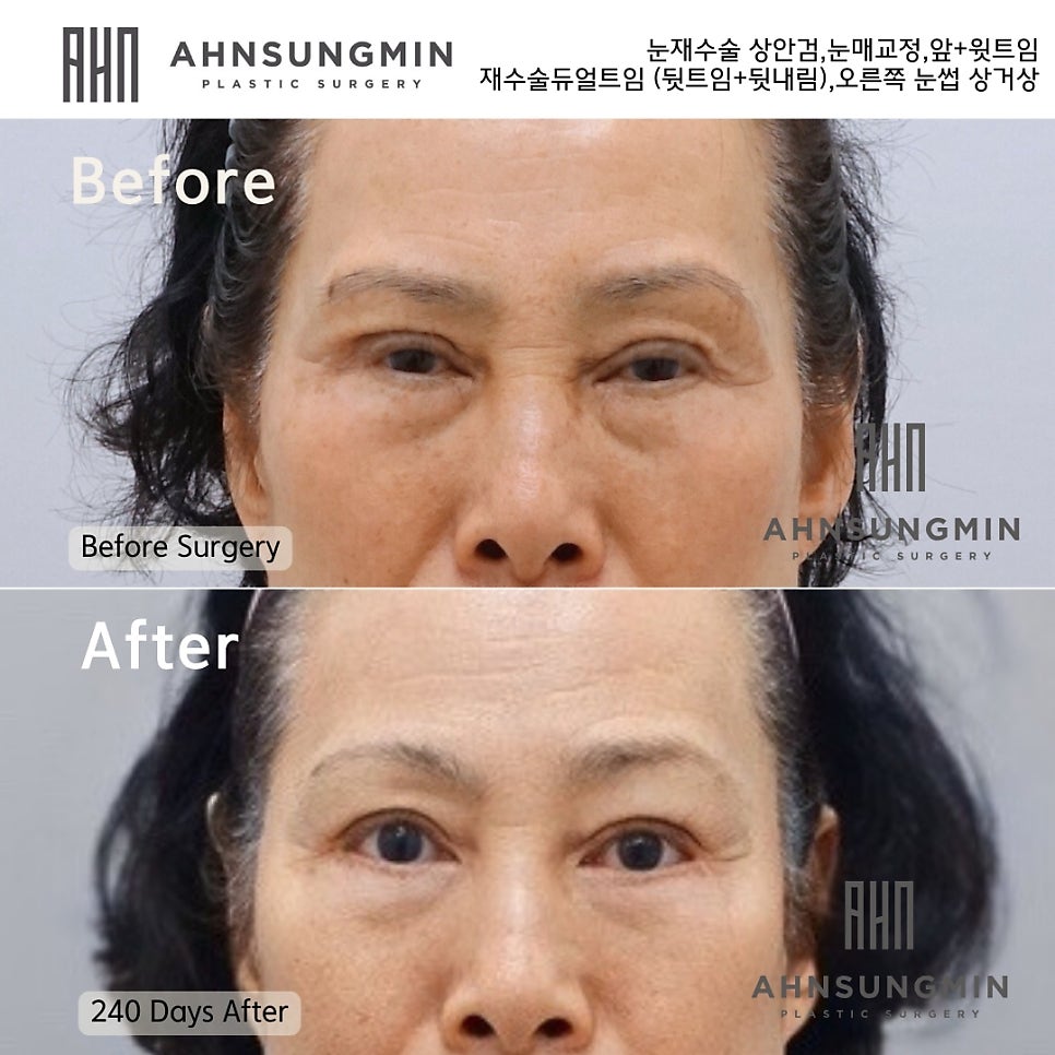눈재수술 눈매교정재수술 트임 재수술 눈썹상거상 관련 이미지 3