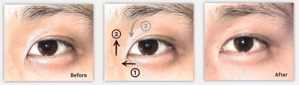앞트임 수술이란? 내안각 교정술 Epicanthoplasty, 몽고주름 앞트임 성형술 관련 이미지 4