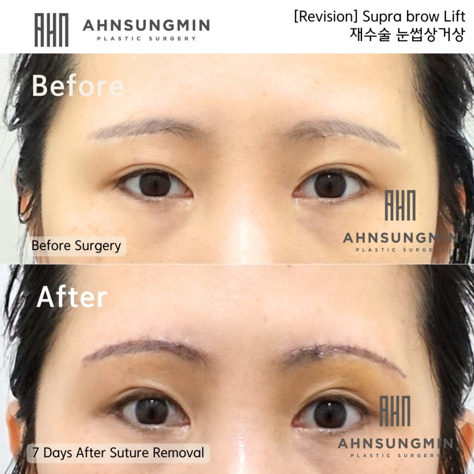 눈썹 상거상 수술이 필요한 이유와 눈썹 하거상 수술의 부작용 관련 이미지 7