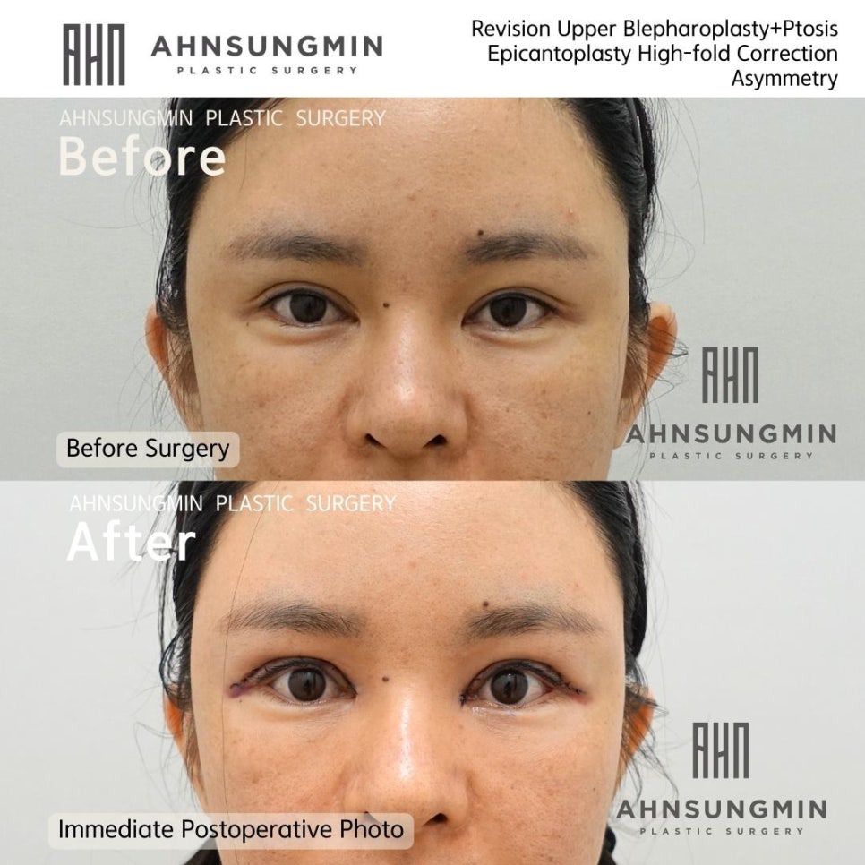 안검하수 짝짝이 눈매교정 앞트임 복원 재수술 전문 관련 이미지 2