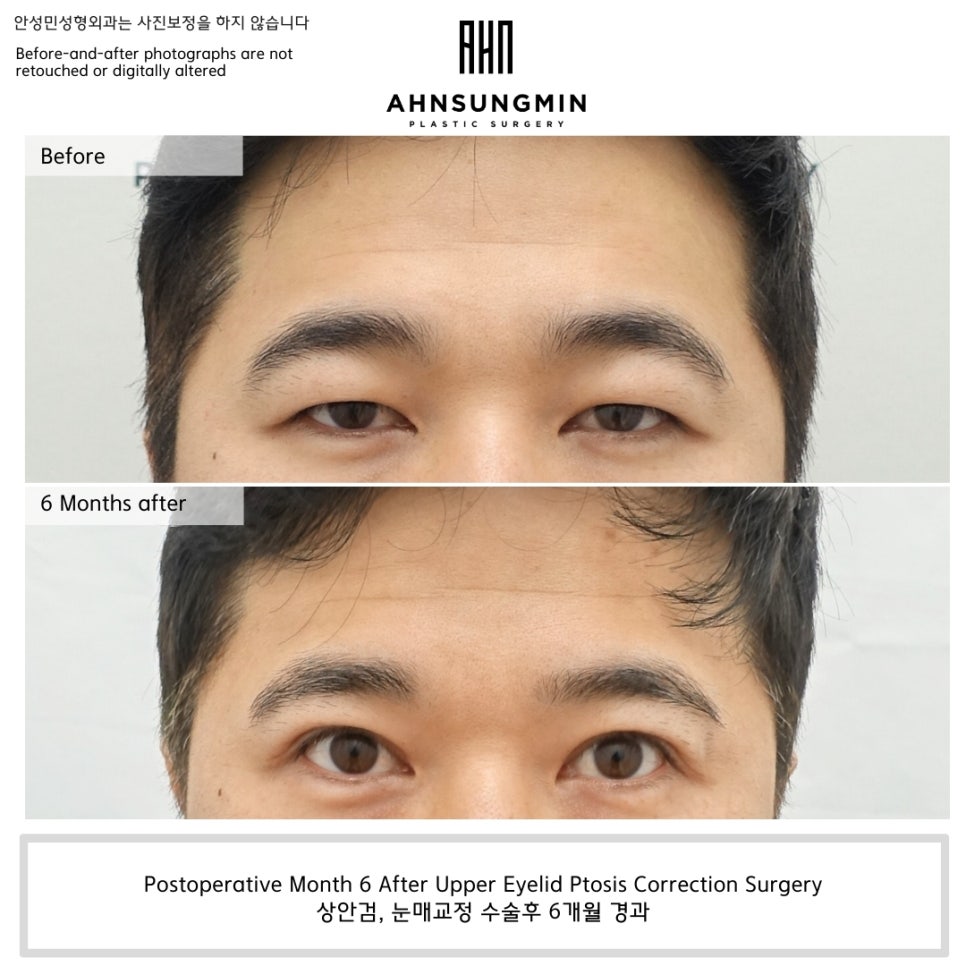 상안검, 눈매교정 수술 후 6개월 경과 &ndash; 눈뜨는 힘이 달라지면 인상이 달라집니다 관련 이미지 3