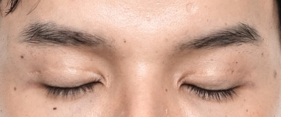 소세지눈 쌍꺼풀 풀기 재수술로 해결 관련 이미지 1