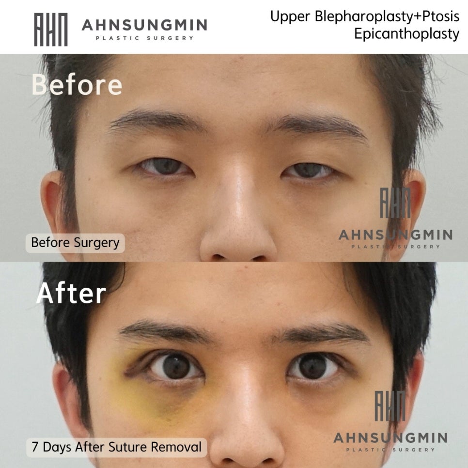 20대 남성 안검하수 눈매교정이 필요한 이유 관련 이미지 4