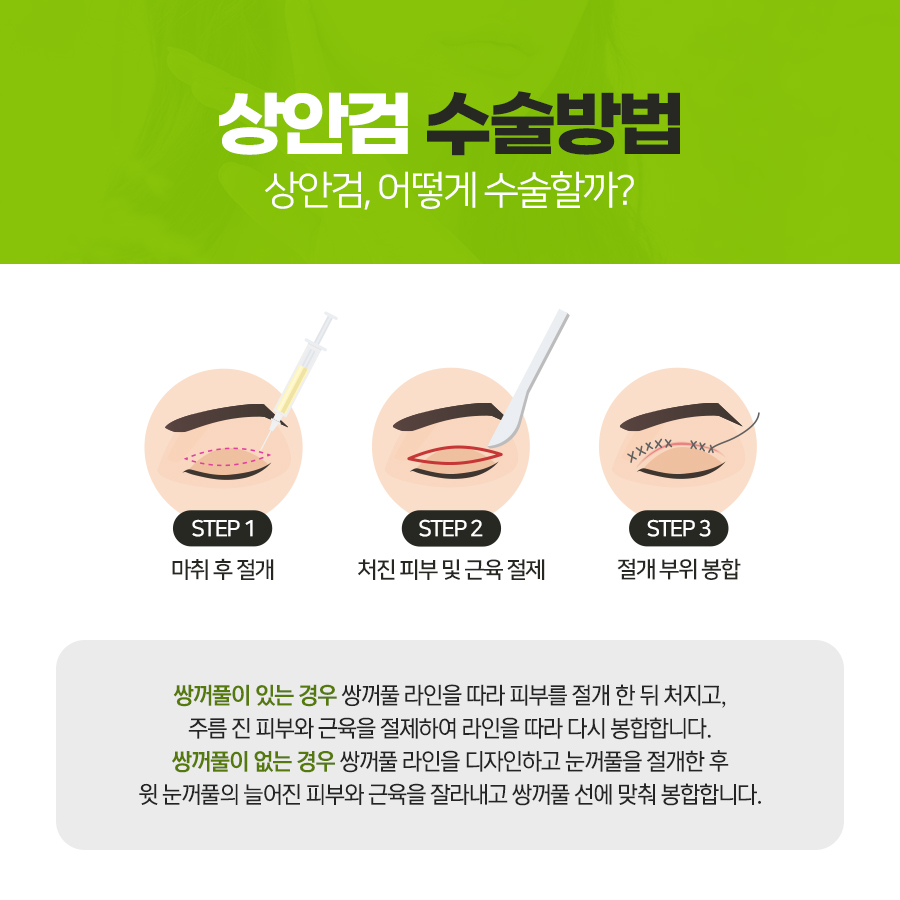 상안검수술은 이럴 때 고민하세요~ 관련 이미지 3