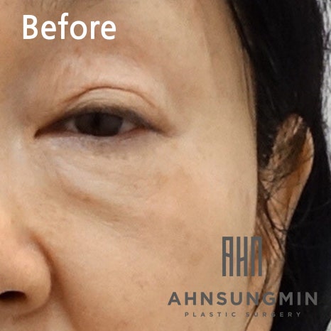 중년 눈 밑 지방재배치 애굣살(애교살) 보존 이유 관련 이미지 3