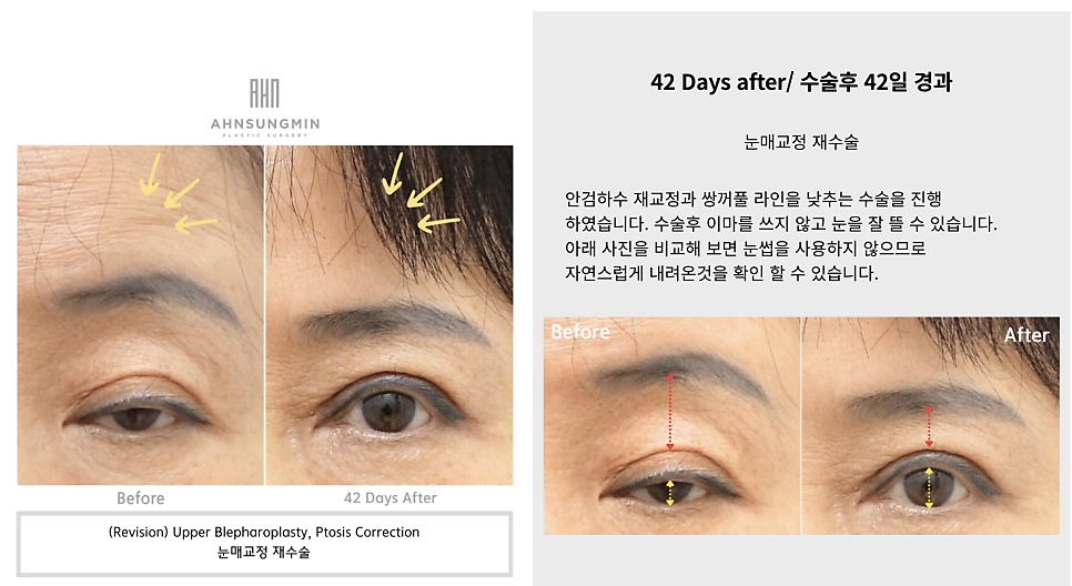중년 눈 재수술 근본적인 문제 해결 맞춤 재수술 관련 이미지 4