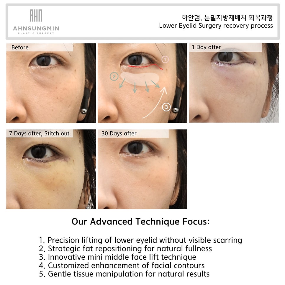 하안검 수술을 통한 눈밑지방재배치 [성형외과 전문의 안성민] 관련 이미지 3