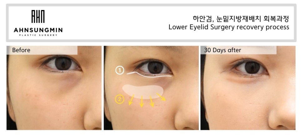 젊은 여성의 하안검, 눈밑지방재배치 수술 애굣살 보존의 중요성 관련 이미지 3