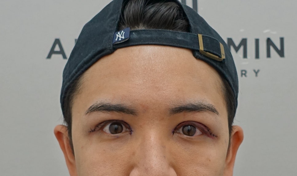 쌍꺼풀 비대칭과 비후증의 원인과 해결 방법, 성형외과 전문의 안성민 관련 이미지 5