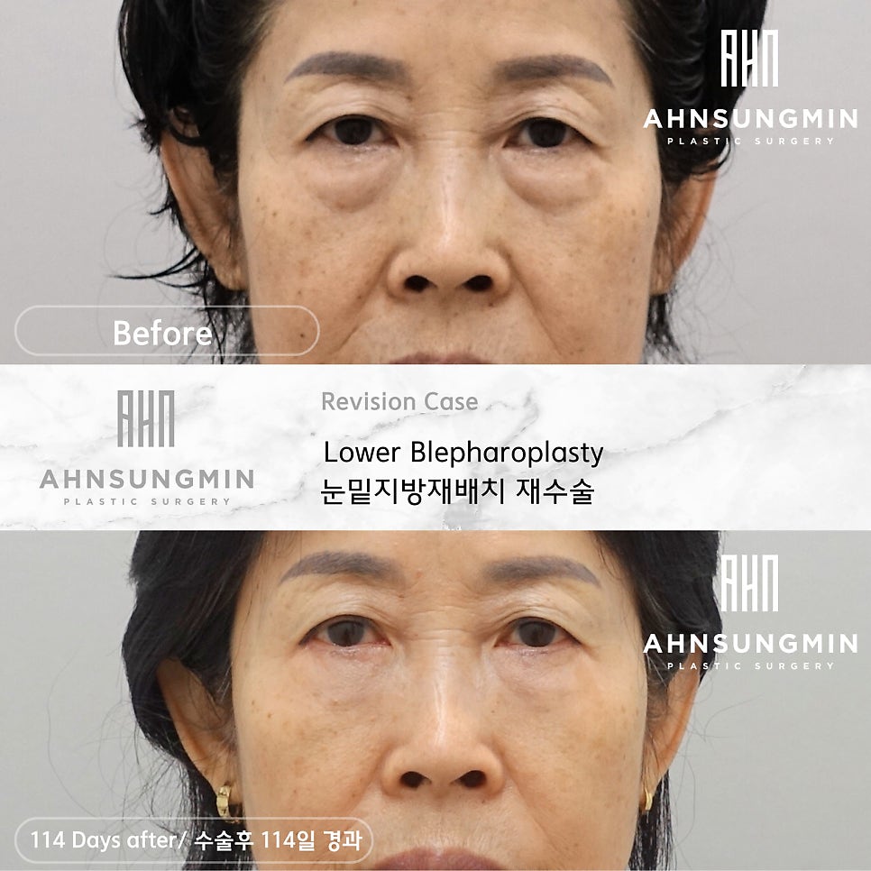 [하안검 재수술의 진실] 하안검도 재수술이 가능할까? 관련 이미지 2
