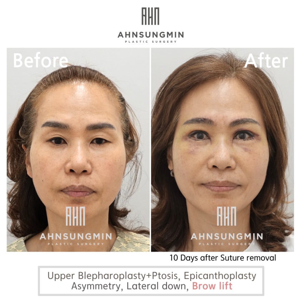 눈썹상거상 수술 전후 눈썹의 위치 관련 이미지 4