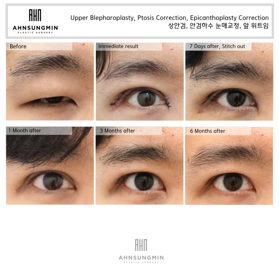 20대 남자 안검하수, 졸린 눈 어떻게 해결할까? 관련 이미지 4