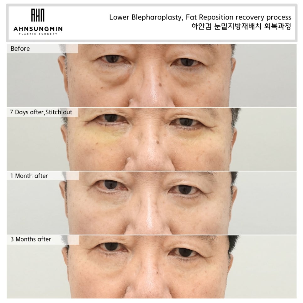 하안검 수술과 혈압관리, 아스피린을 끈어야 하는 이유 관련 이미지 2