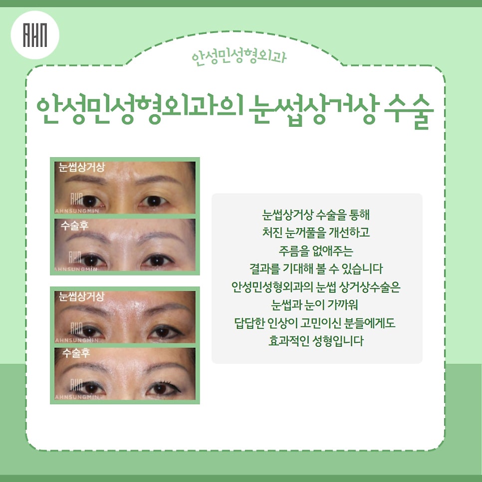 눈썹상거상 꼭 필요할까? 관련 이미지 9