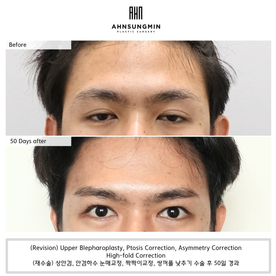 [재수술] 남자 쌍꺼풀이 두꺼워 보이는 원인은 안검하수 관련 이미지 3