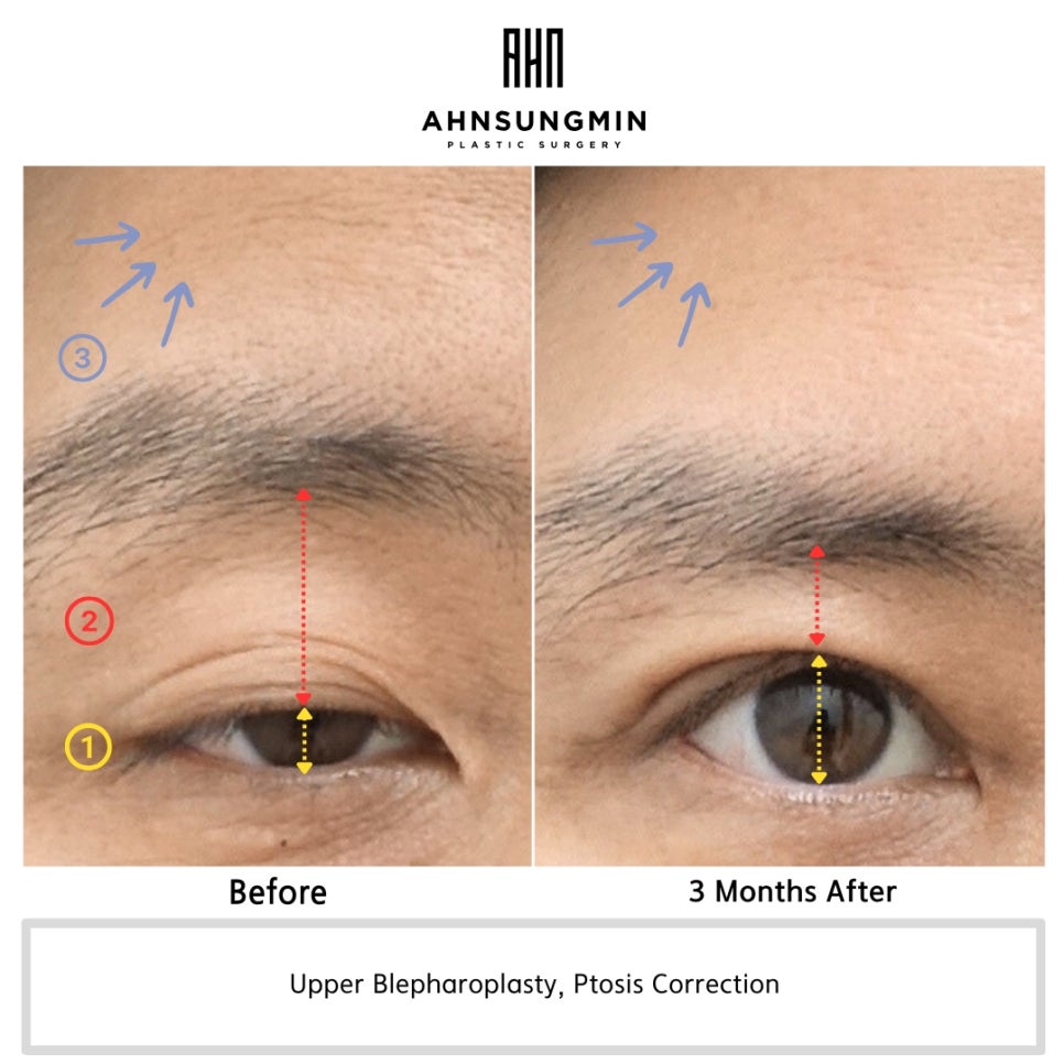 40대 남성 눈매교정 수술, 안검하수 개선과 자연스러운 회복 과정 관련 이미지 3