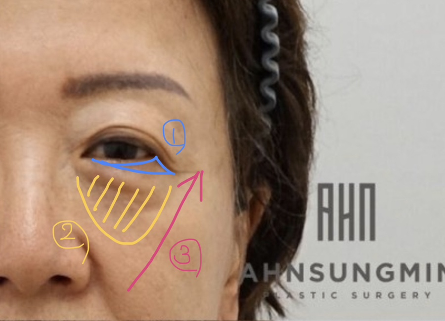 하안검 눈밑지방재배치 수술과 수술시 주의점 관련 이미지 3