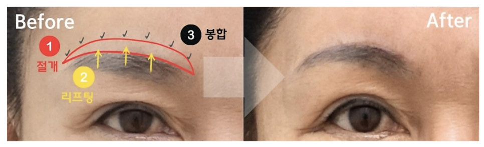 눈썹 거상 수술 효과와 흉터 변화 관련 이미지 3