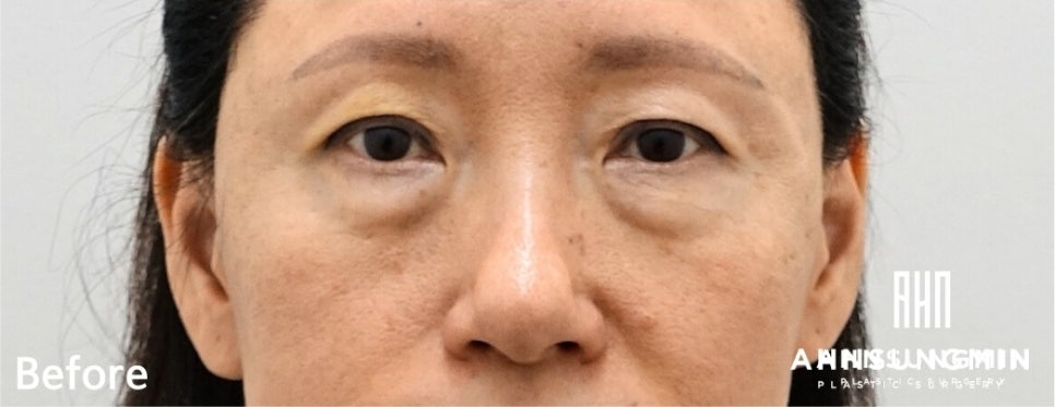 불룩한 눈 밑 지방, 해결할 수 있을까? 관련 이미지 3