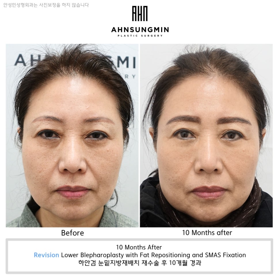 하안검 눈밑지방재배치 재수술, 수술 전후로 살펴봅니다 관련 이미지 1