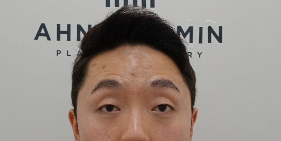 남자 안검하수, 눈이 커지고 싶어요 관련 이미지 2