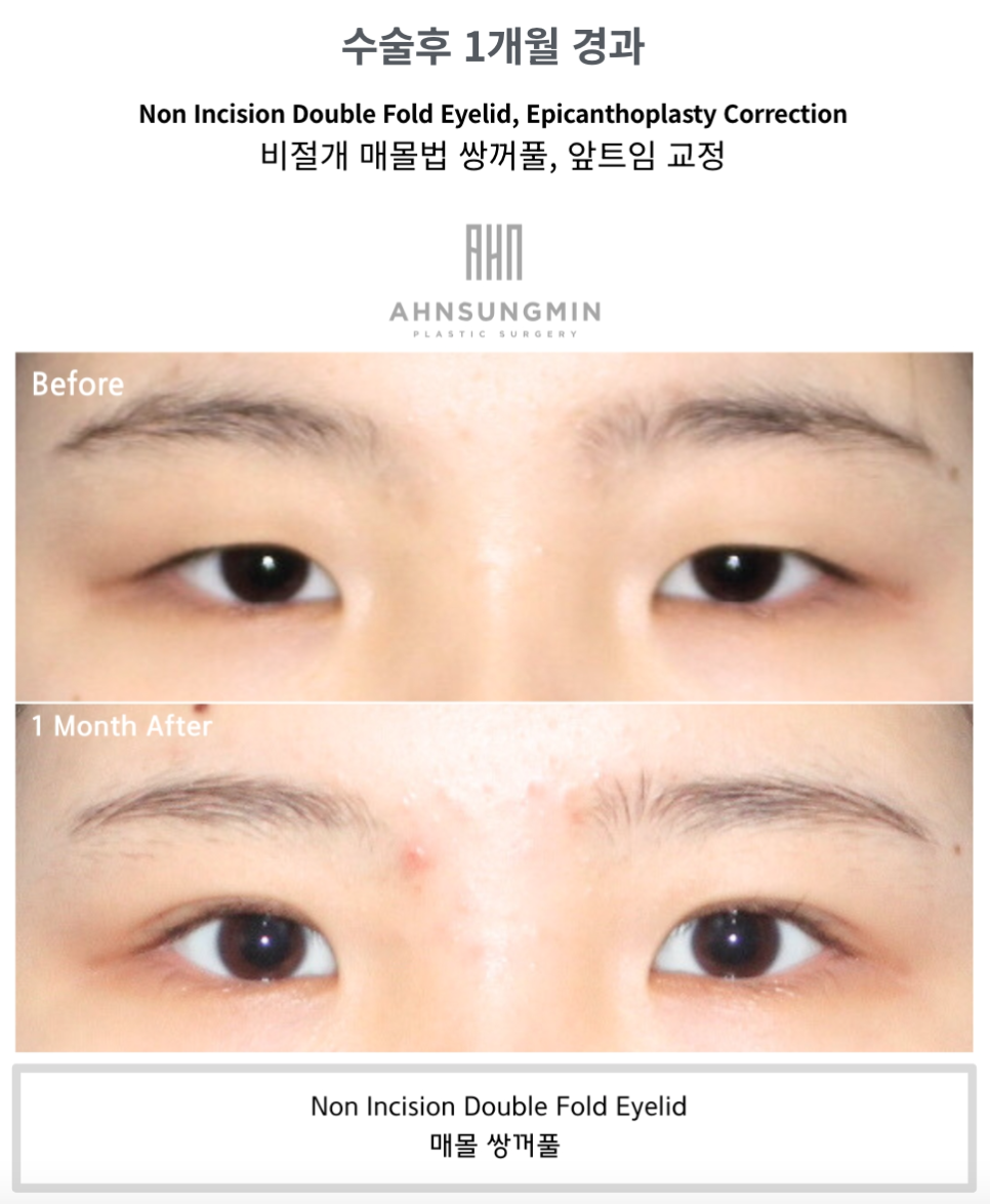 절개쌍꺼풀과 비절개쌍꺼풀 비교 관련 이미지 2
