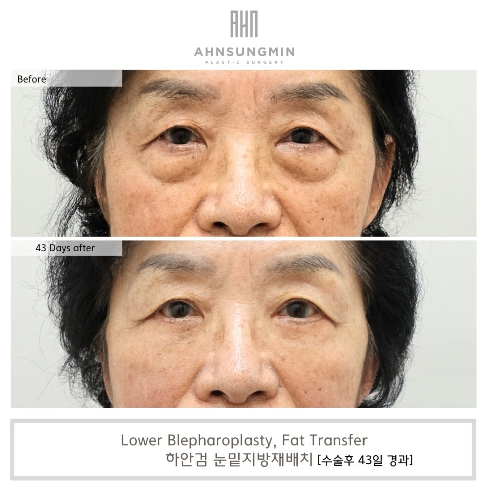 하안검 수술 시 중안면 근육 거상의 중요성 [성형외과 전문의 안성민] 관련 이미지 3
