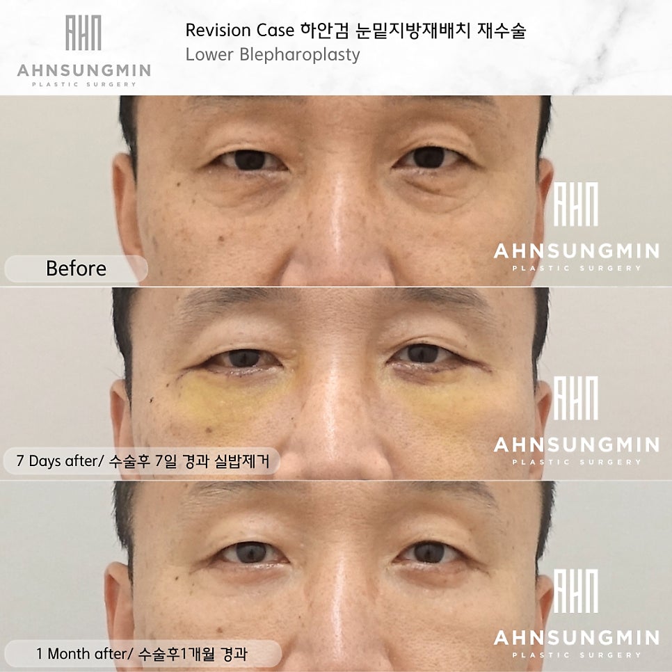 중년 하안검, 눈 밑 지방재배치 재수술 근본적인 원인을 해결하다. 관련 이미지 2