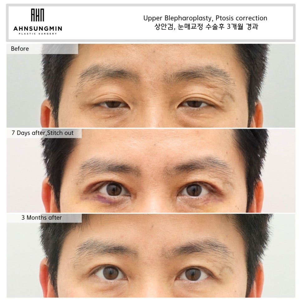 남자 안검하수, 눈이 커지고 싶어요 관련 이미지 3