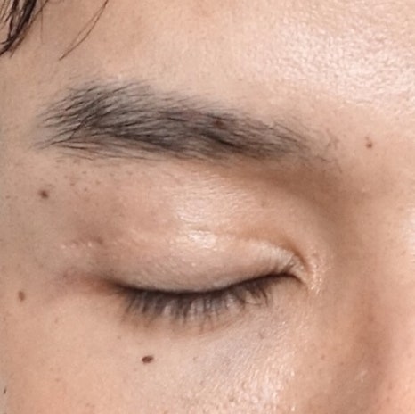 남자 눈성형 두꺼운 쌍꺼풀 풀기 관련 이미지 9