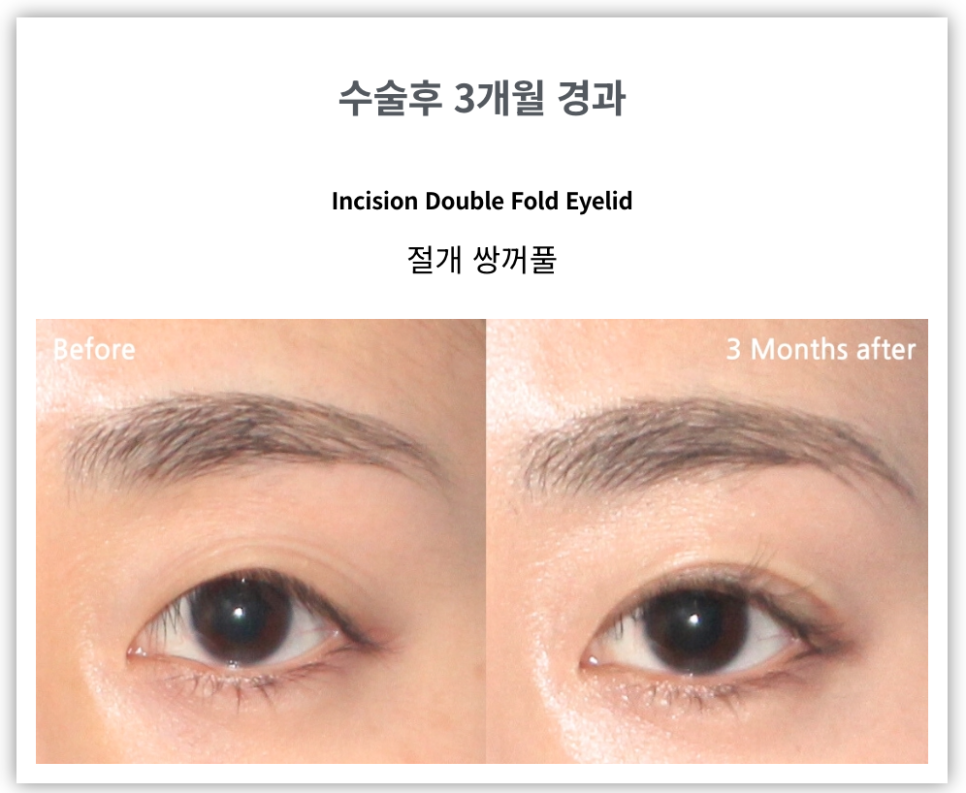 절개쌍꺼풀과 비절개쌍꺼풀 비교 관련 이미지 5