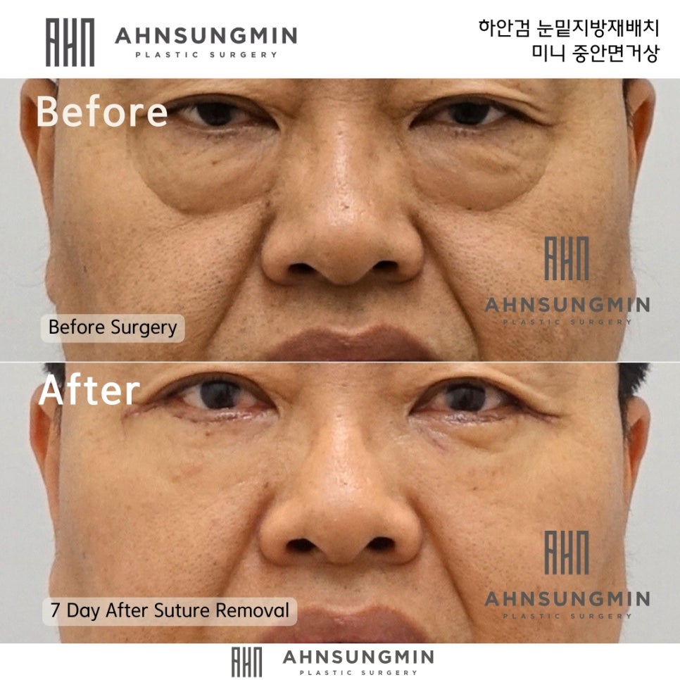 중년 남성 하안검 처짐현상 격막강화가 필요한 이유 관련 이미지 2