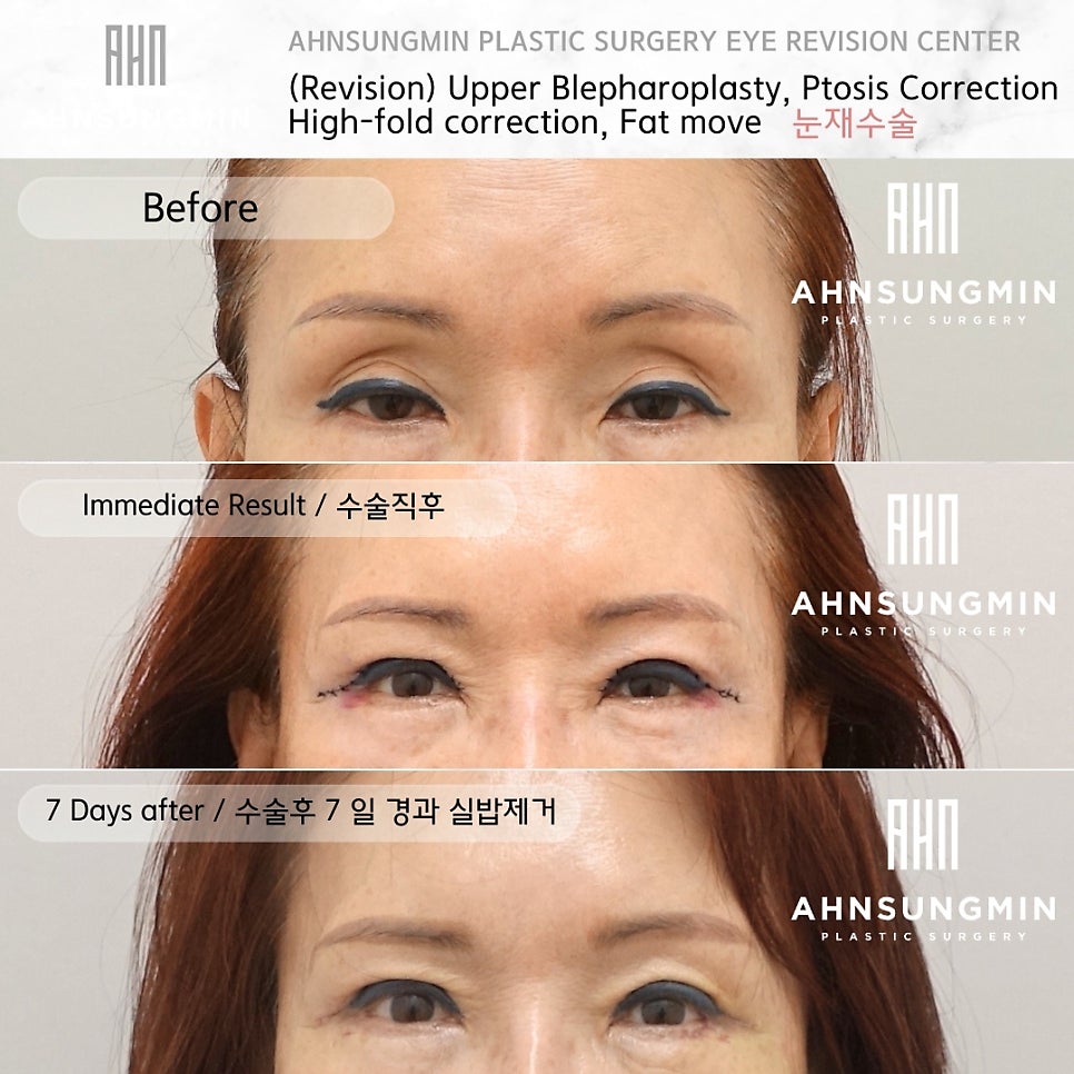 중년 자연스러운 쌍꺼풀 재수술 잘하는 곳, 안성민성형외과 관련 이미지 3