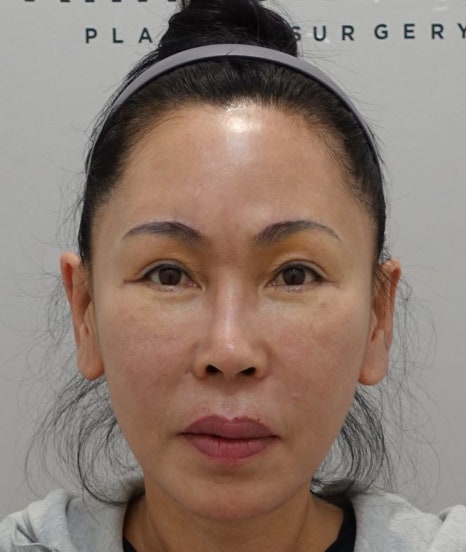 눈썹 거상 수술 후 30일 경과, 1년 경과 관련 이미지 5