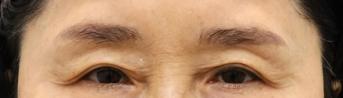 60대 눈썹상거상술 전후 비교, 눈이 편안해진 이유 관련 이미지 1