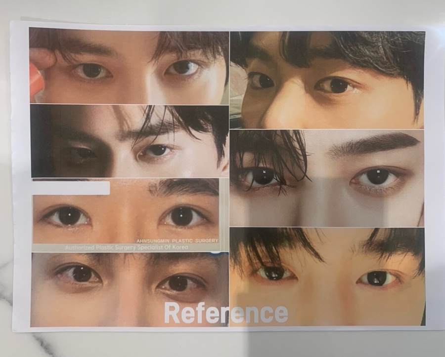20대 남자 안검하수 수술 전후, 성형외과 전문의 관련 이미지 1