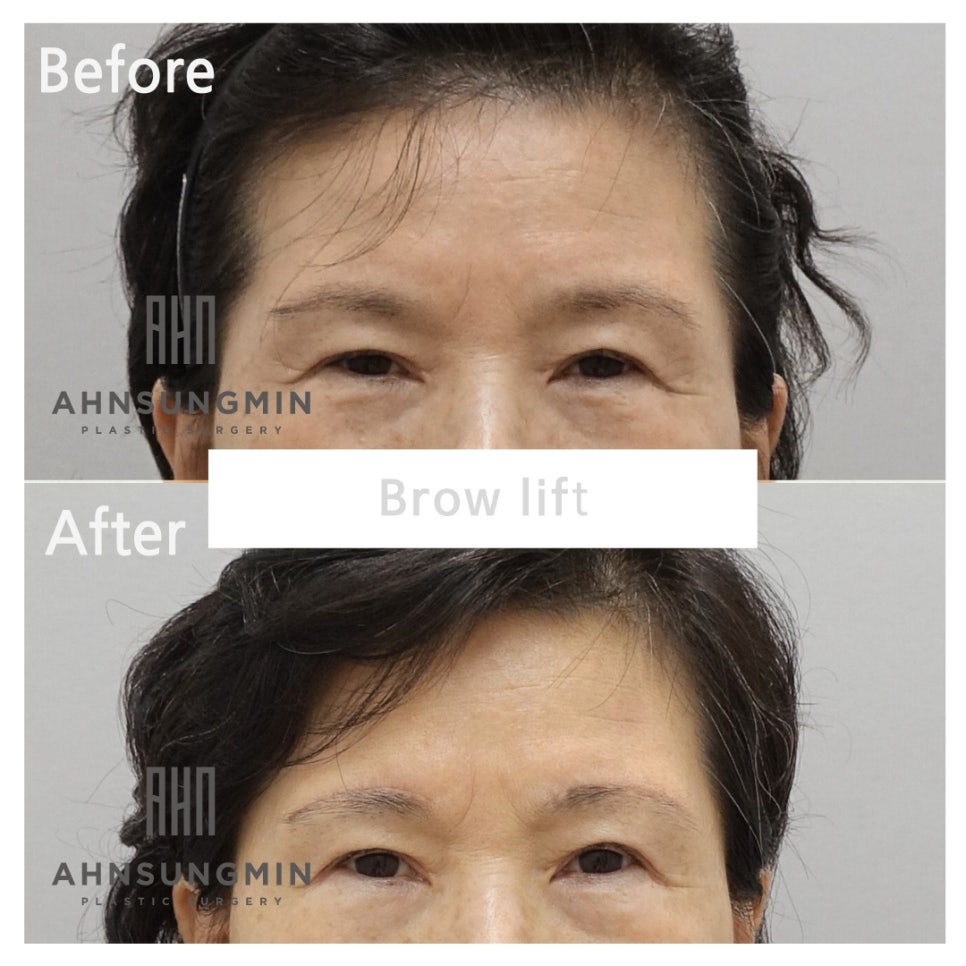 눈썹하거상 수술의 부작용과 눈썹상거상 수술이 필요한이유[성형외과 전문의] 관련 이미지 3