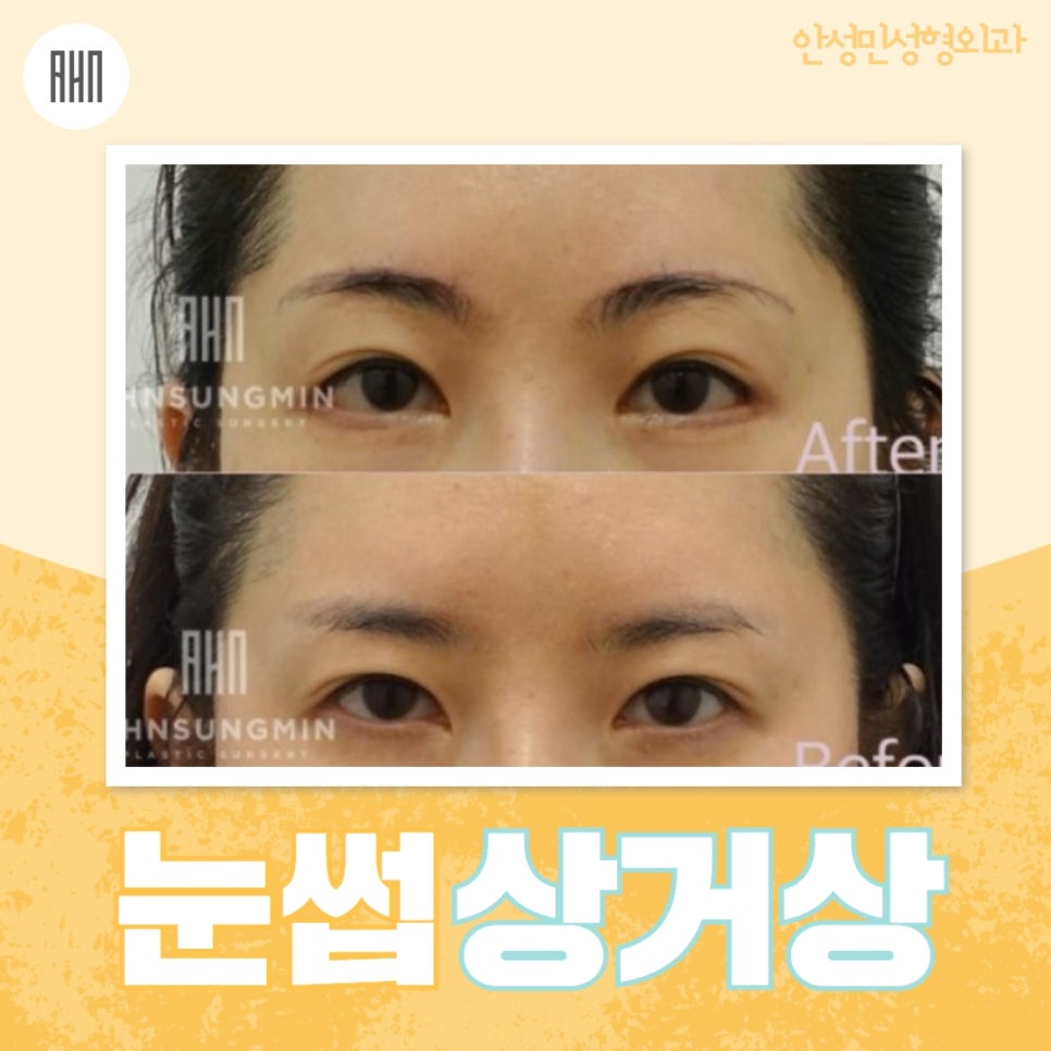 눈썹상거상 꼭 필요할까? 관련 이미지 1