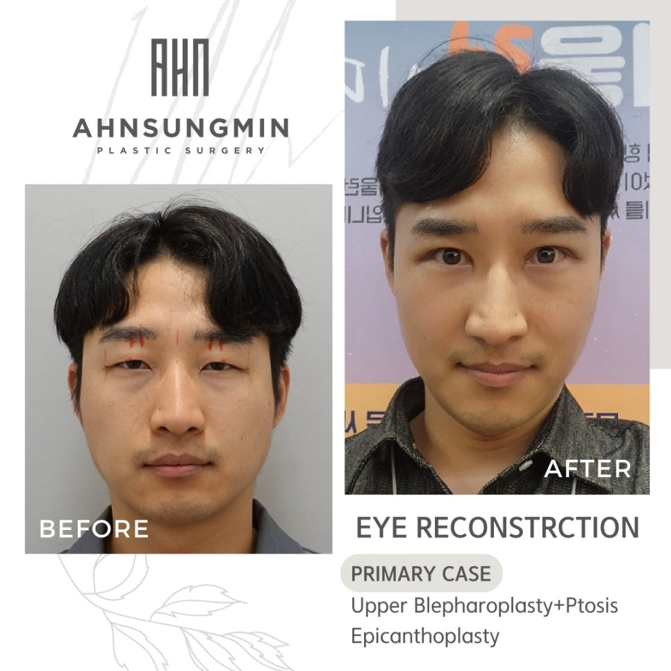 남자 안검하수 눈매교정 진성 안검하수 관련 이미지 2