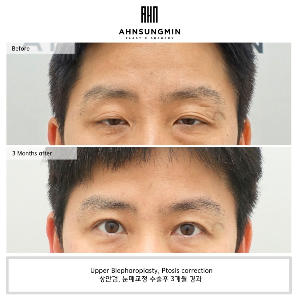 40대 남성 눈매교정 수술, 안검하수 개선과 자연스러운 회복 과정 관련 이미지 1